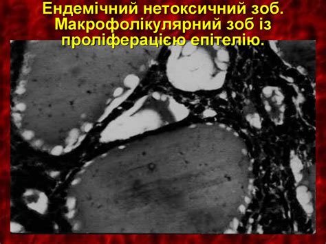 Захворювання щитоподібної залози - презентация онлайн