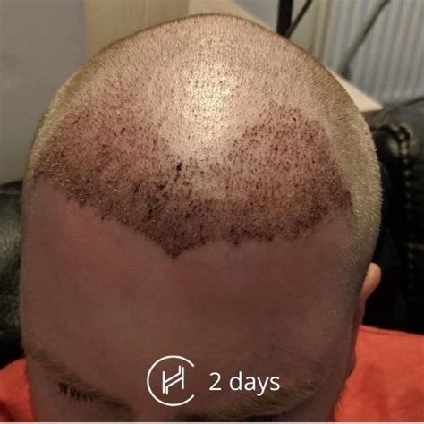 Hair Transplant Recovery Timeline | 0 - 14 Months Photos