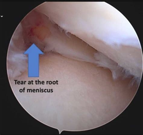 Meniscus Root Tear Repair | Orthopedic Knee Surgeon | Manhattan, New ...