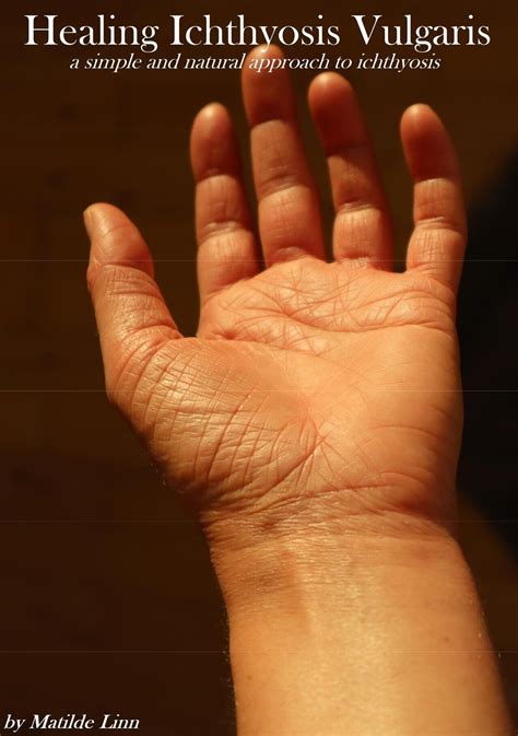 Ichthyosis Vulgaris