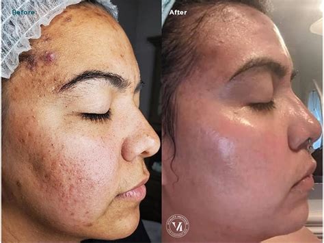 Acne Scars Treatment - Best of Atlanta Winner 2025 | ELLEMES Medical Spa