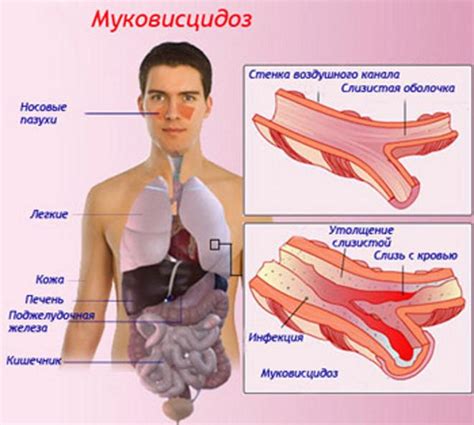 Муковисцидоз – это что за болезнь и как она выглядит. Фото ...