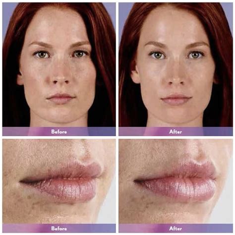 Teosyal vs Juvederm | Difference Teoxane Filler vs Juvederm Filler