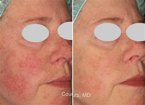 Rosacea Treatment | Reduce Redness | Skin Doctor Clinics