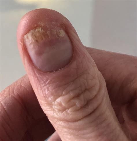 Red Light - Heals Fungus + Nail Regrows Where Damaged : r