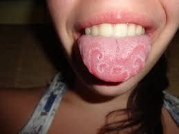 White Coating On Tongue: Causes, Picture, Symptoms, Treatment