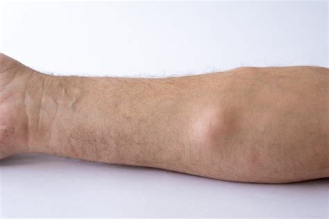 Warts vs. Corns: What’s the Difference? - Aventus Clinic