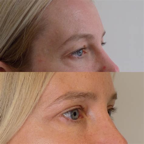 Blepharoplasty | Dr Fiumara 5* Natural Results