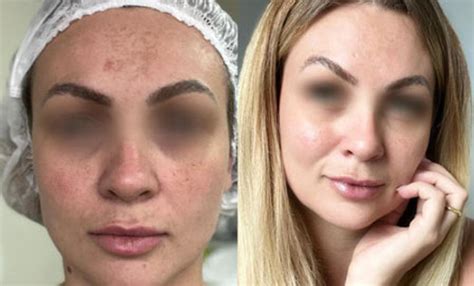 Clareamento A Laser De Pele - Lavieen BB Laser | Jess Corporal - Rejuvenescimento e Clareamento da ...