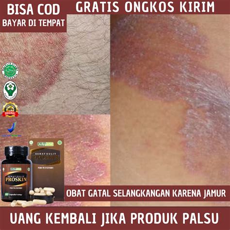 cara mengatasi miss v gatal setelah berhubungan 4