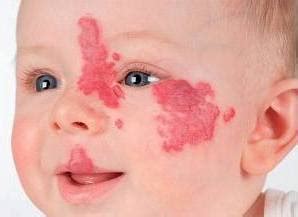 Hemangiomas (Infantile)