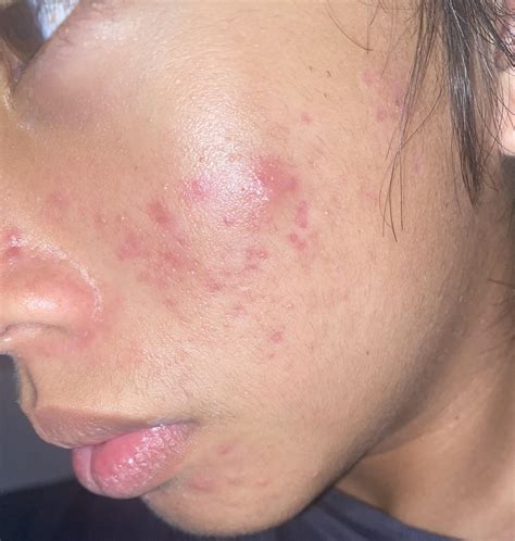 Please help, i dont know what to do anymore : r/acne