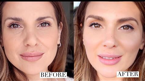 How i got rid of under eye hollows and improved my overall look ali ...