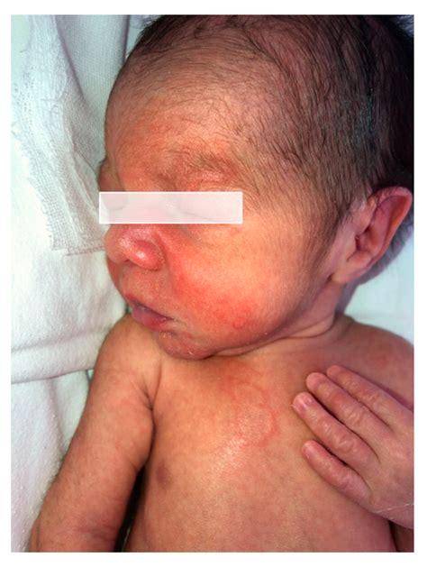 Gestational Pemphigoid