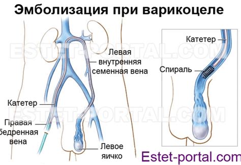 Варикоцеле: опасное заболевание молодых мужчин - Estet-Portal