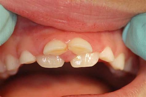 Two Sets Of Teeth