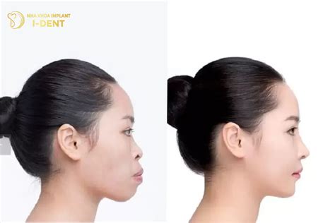 truoc va sau khi nieng rang  lam thay doi khuon mat