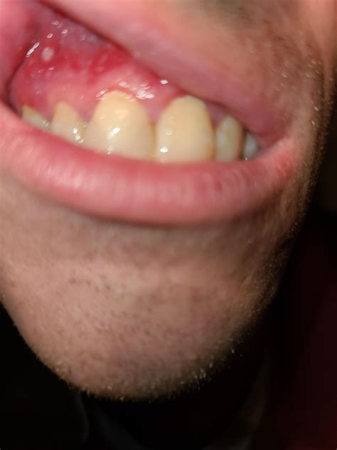 Is this a canker sore? I went to urgent care yesterday to try and get ...