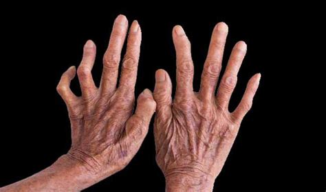 indonesia penyumbang kusta ketiga  dunia