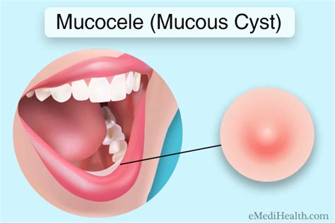 Mucous Cyst Lip Treatment At Home - Infoupdate.org