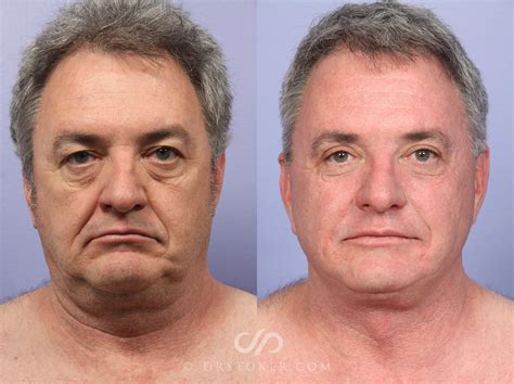 face lift surgeries 3
