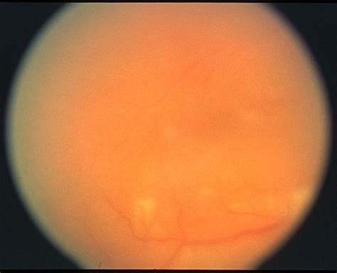 oftalmoloska poliklinika dr balog vitritis  vitreitis