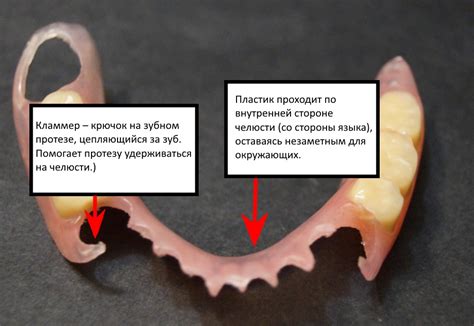 Пластиночный (акриловый) съёмный протез - стоматология Мытищи