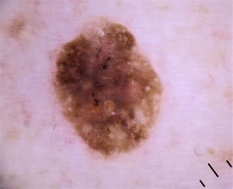 Dermoscopy | Melanoma skin cancer can be fatal unless caught early, but
