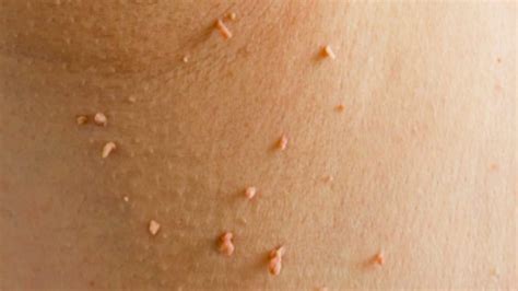 easy home remedies  skin tags  plantar warts  recipes
