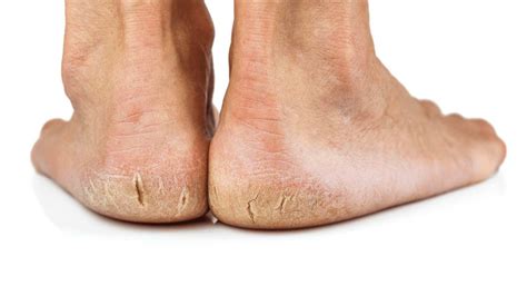 remedy  severely cracked heels  bellvalefarmscom