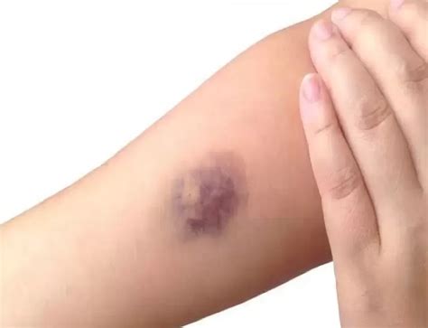 tiba tiba memar  lebam   penyakit  perlu diwaspadai radar