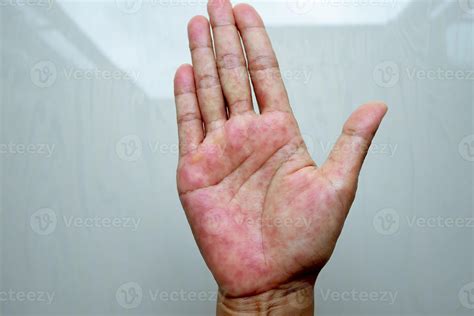 Atopic Dermatitis Fingers