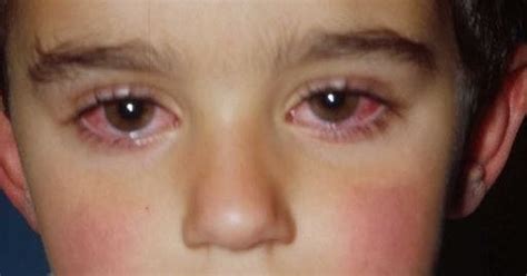 Pediatrics Notes: Approach to a Child With Eye Discharge and Swelling