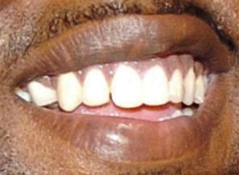 Kanye West's Teeth Pictures