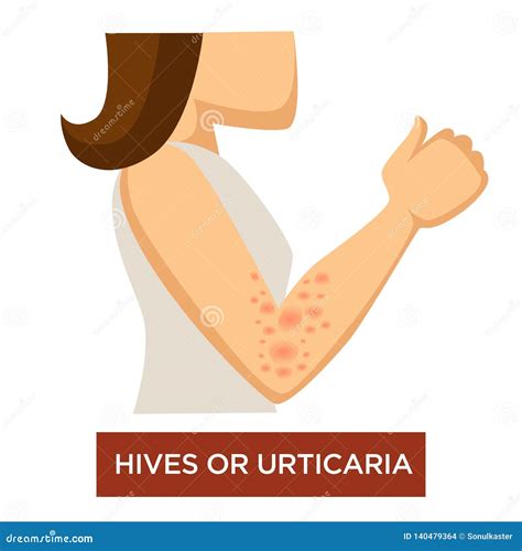 Hives Or Urticaria Disease Skin Inflammation Immune System Damage