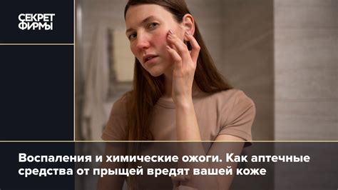 Почему аптечные средства от прыщей бесполезны: Жизнь — Секрет фирмы