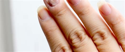Do Over-the-Counter Toenail Fungus Medications Work?