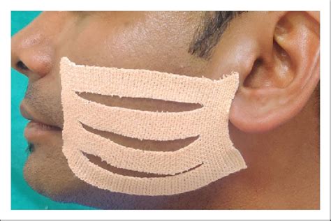 technique  tape application  scientific diagram