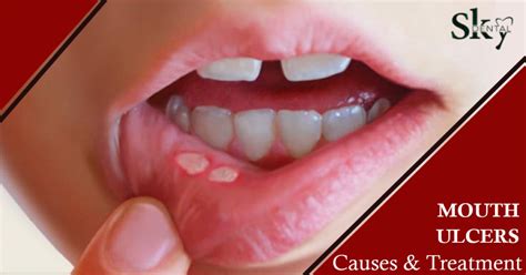 mouth ulcers treatment  tips sky dental care