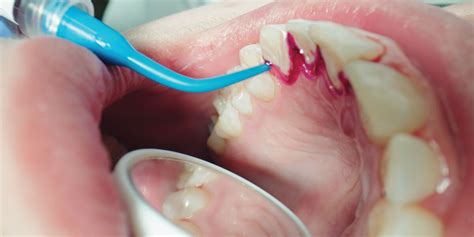 perio management young innovations