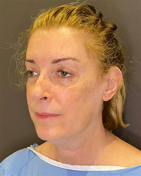 Patient 149616 | Top Surgery Before & After Photos | Albert Plastic Surgery