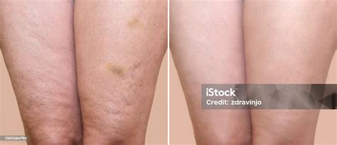 Thighs Of A Woman Before And After Medical Treatment Stock Photo ...
