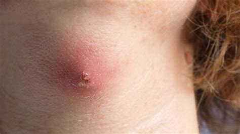 Incision and Drainage of Abscesses: Dubai's Medical Excellence | Vipon