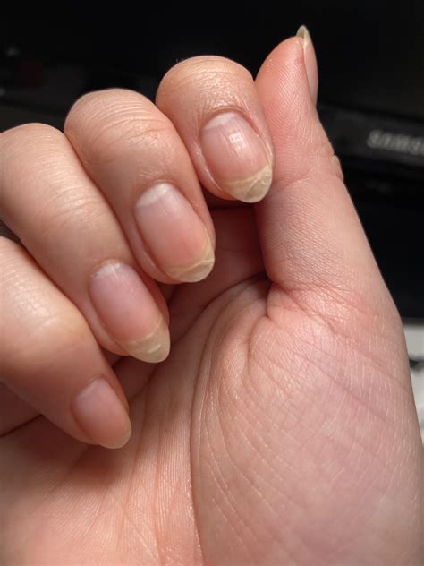 How to fix peeling nails? : r/Nails