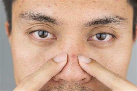 Popping Blackheads Nose