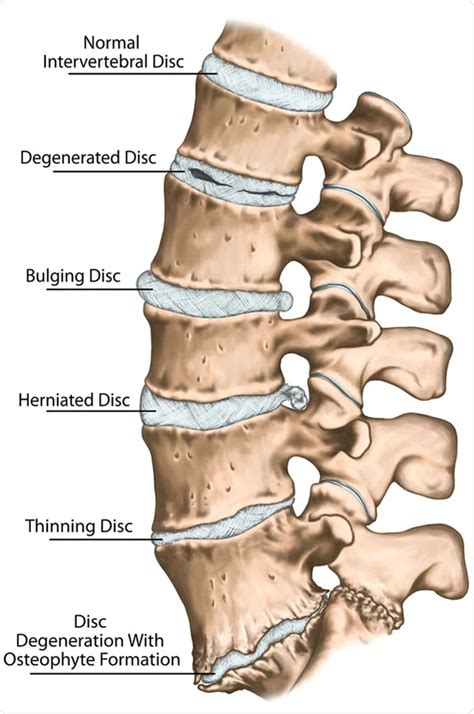 degenerative disc disease treatment   care