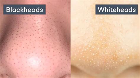 Understanding Blackheads and Whiteheads: Causes, Differences, and Simi ...