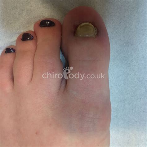 Nail reconstruction | Services | Liverpool Podiatry | Leading podiatry
