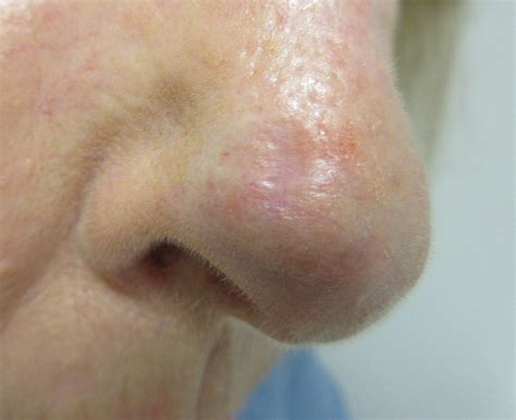 Basal Cell Carcinoma Pictures | Visual BCC Examples by Mr Tehrani