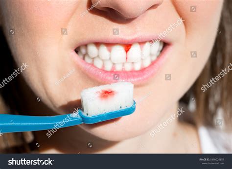 how to fix gingivitis